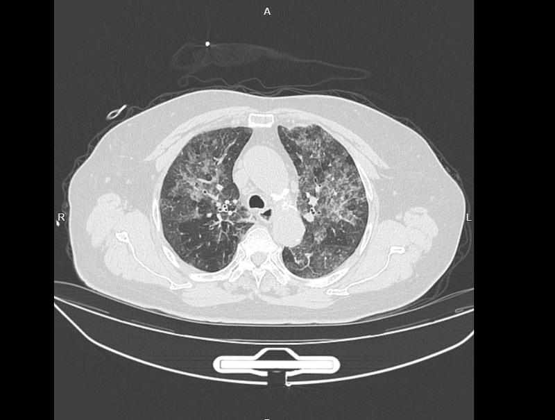 虔心祈福却换来肺部危机;长时间香火环境引发过敏性肺泡炎,专家详解防范之道。 健康养生