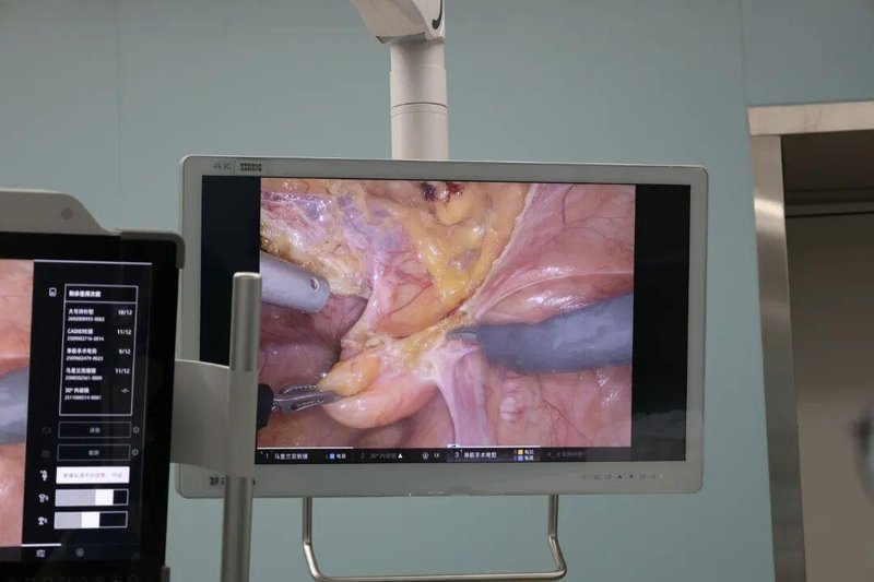  机器人腹腔镜手术落地大理：技术普惠的里程碑时刻 健康养生